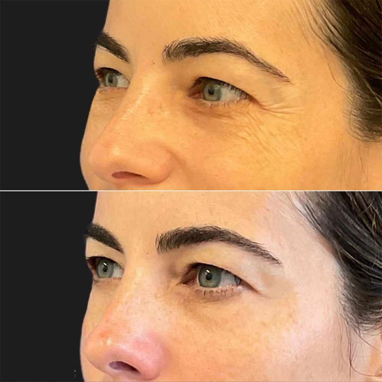 تزریق بوتاکس دور چشم هروی 